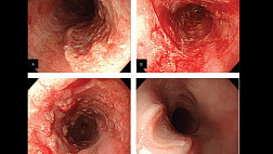 Цитомегаловирусный эзофагит (ЦМВ-эзофагит)
